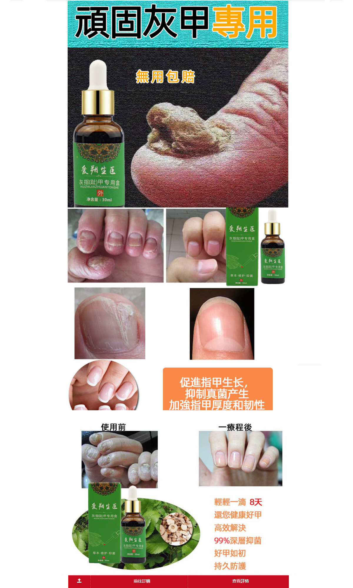 新亮鉀灰甲藥抑菌液店-治療頑固灰指甲外用藥,如何根治方法推薦